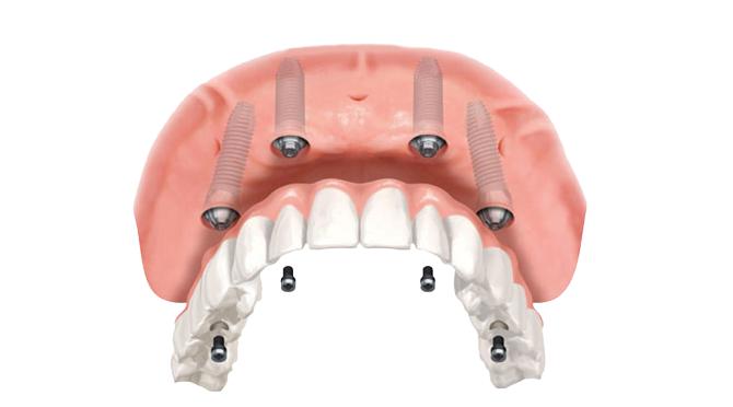 Protese Dentaria Overdentures Removebg Preview